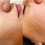 result after Micro-needling Treatment