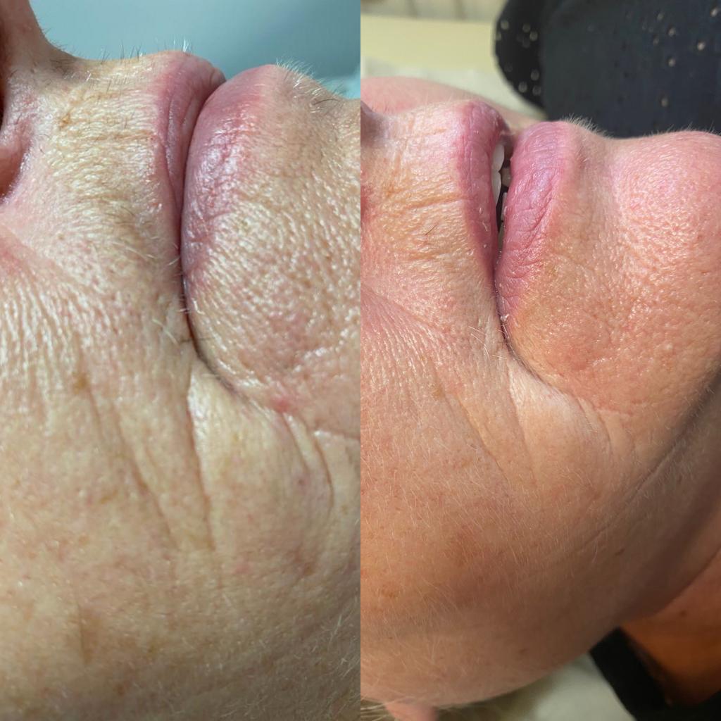 Micro needling Treatment removes the fine lines