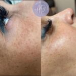 get desirable eyelashes with Micro needling Treatment