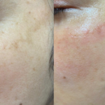 pigmentation after and before Micro needling Treatment